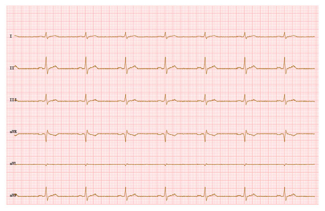 HTML5 Canvas心电图波浪线特效